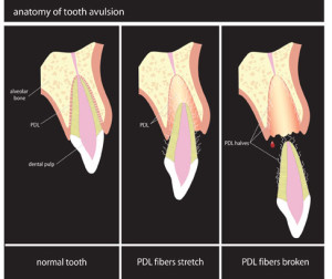 Anatomy of Avulsion