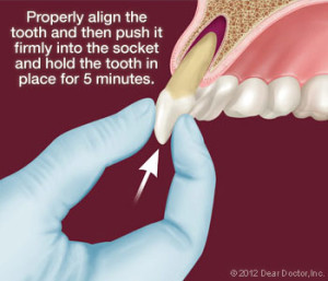 Avulsed tooth