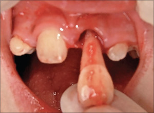 Avulsed tooth close up