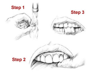 Steps for avulsed tooth