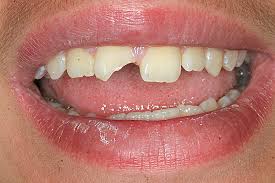 avulsed tooth chipped tooth